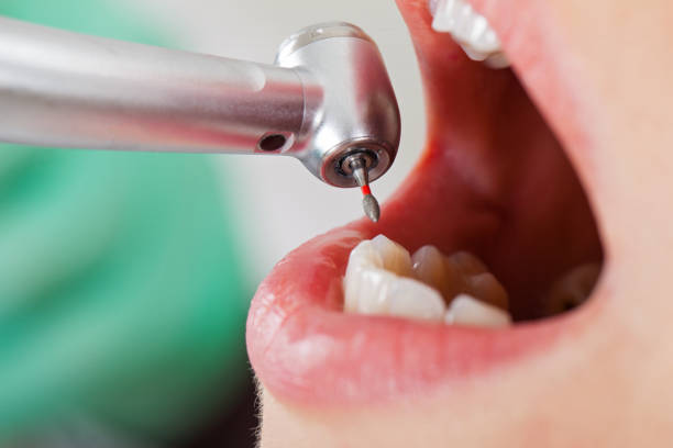 Best Emergency Wisdom Teeth Removal in Sergeant Bluff, IA